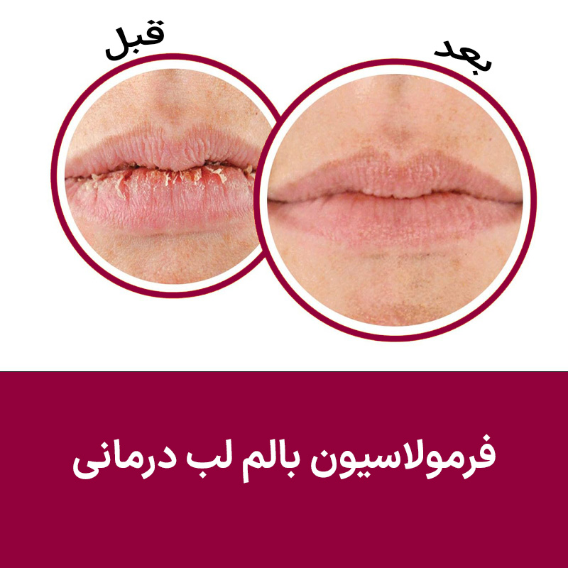 فرمولاسیون بالم لب درمانی
