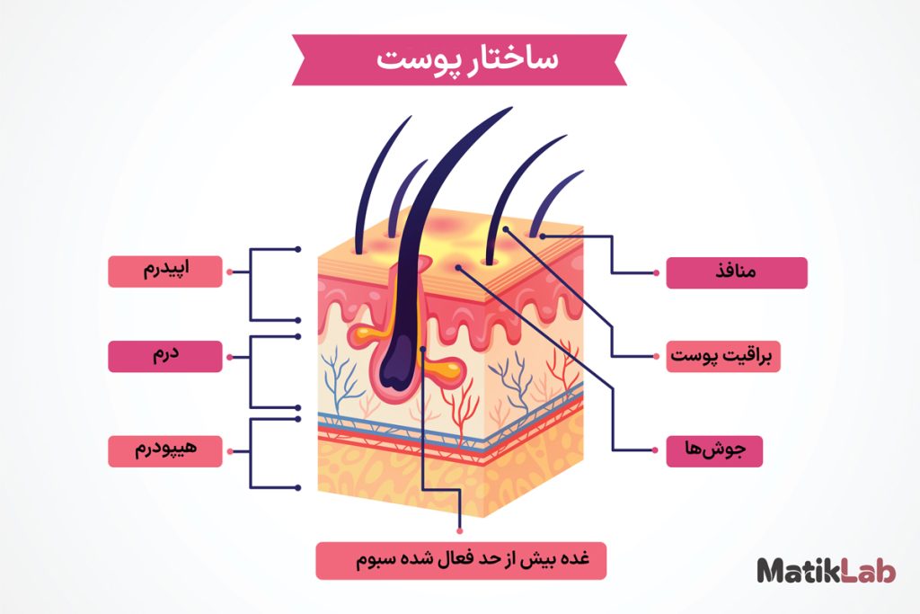 ساختار پوست دارای آکنه